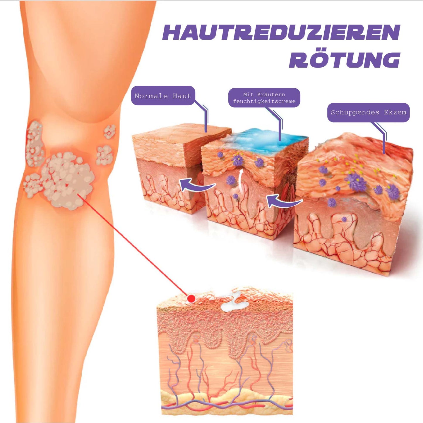 ATTDX SofortigeErleichterung Ekzem ViolaCreme