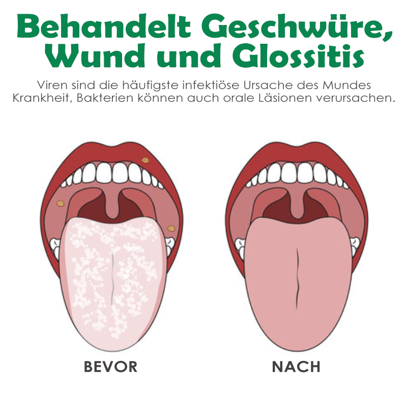 ATTDX Mundpflege Propolis GeschwürErleichterung Sprühen