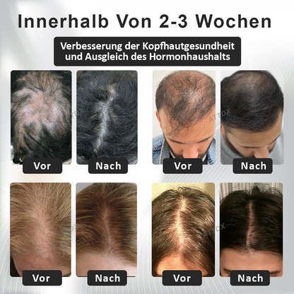 ATTDX™ Alopecia Wiederherstellungs Haar Booster Roll-On