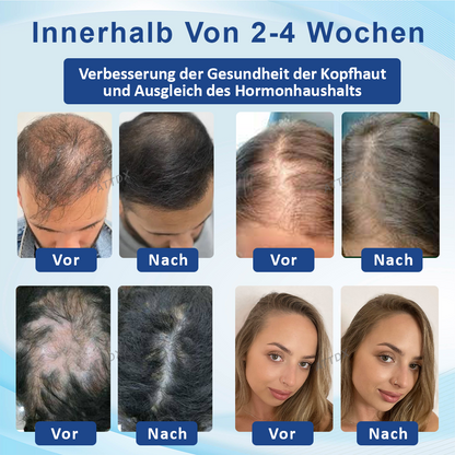 ATTDX™  Alopecia Wiederherstellungs Haarwuchscreme