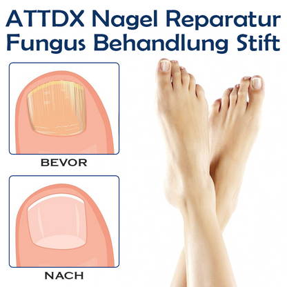 ATTDX Nagel Reparatur Fungus Behandlung Stift