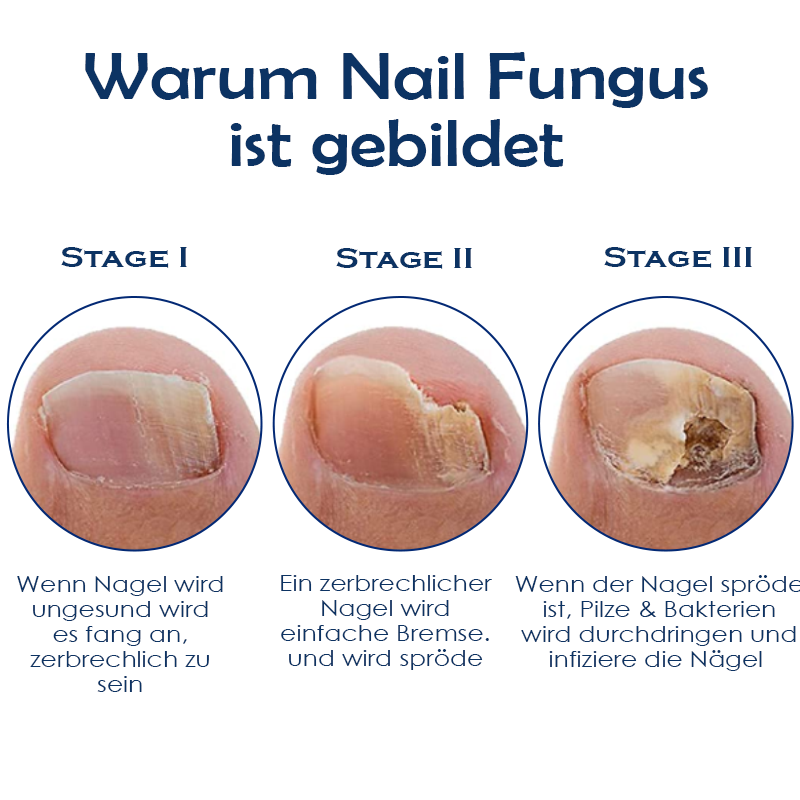 ATTDX Nagel Reparatur Fungus Behandlung Stift