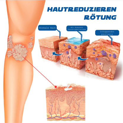 ATTDX Psoriasis Behandlung BieneVenom Creme