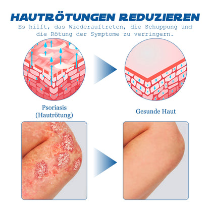 ATTDX Psoriasis Behandlung BieneVenom Creme