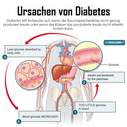 Ricpind ErleichterungZuckerkrankheit KörperBildhauerei HandRiemen